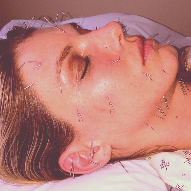 Angela Lindvall shows off her face after acupuncture 