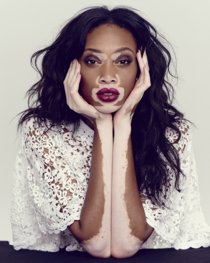 Winnie Harlow Photos Her Campaigns For Desigual And Diesel
