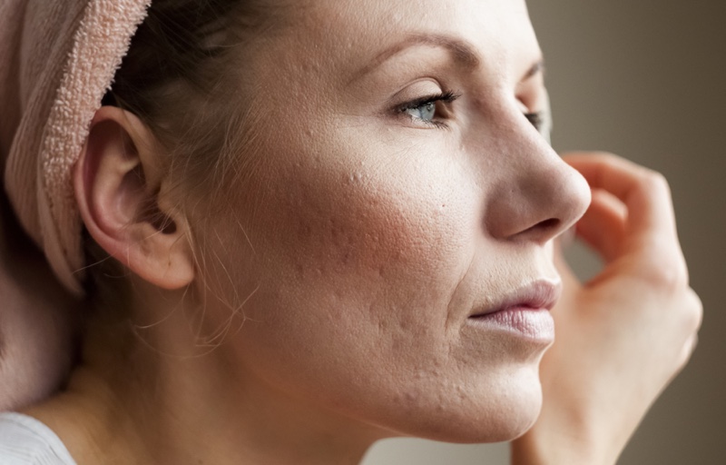 Closeup Woman Acne Scars Skin