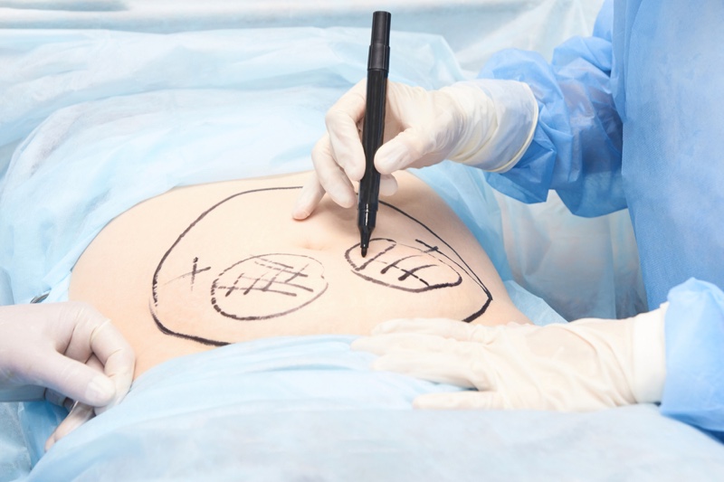 Doctor Liposuction Drawing Stomach