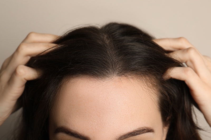 Closeup Woman's Scalp Balding Thinning Hair