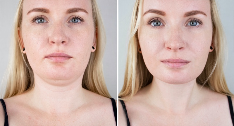 Chin Reduction Surgery Before After